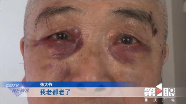 盛宝策略 七旬大爷出门散步被拉去割眼袋，女儿赶到时大爷已出手术室：血从眼角浸出，眼睛都肿了